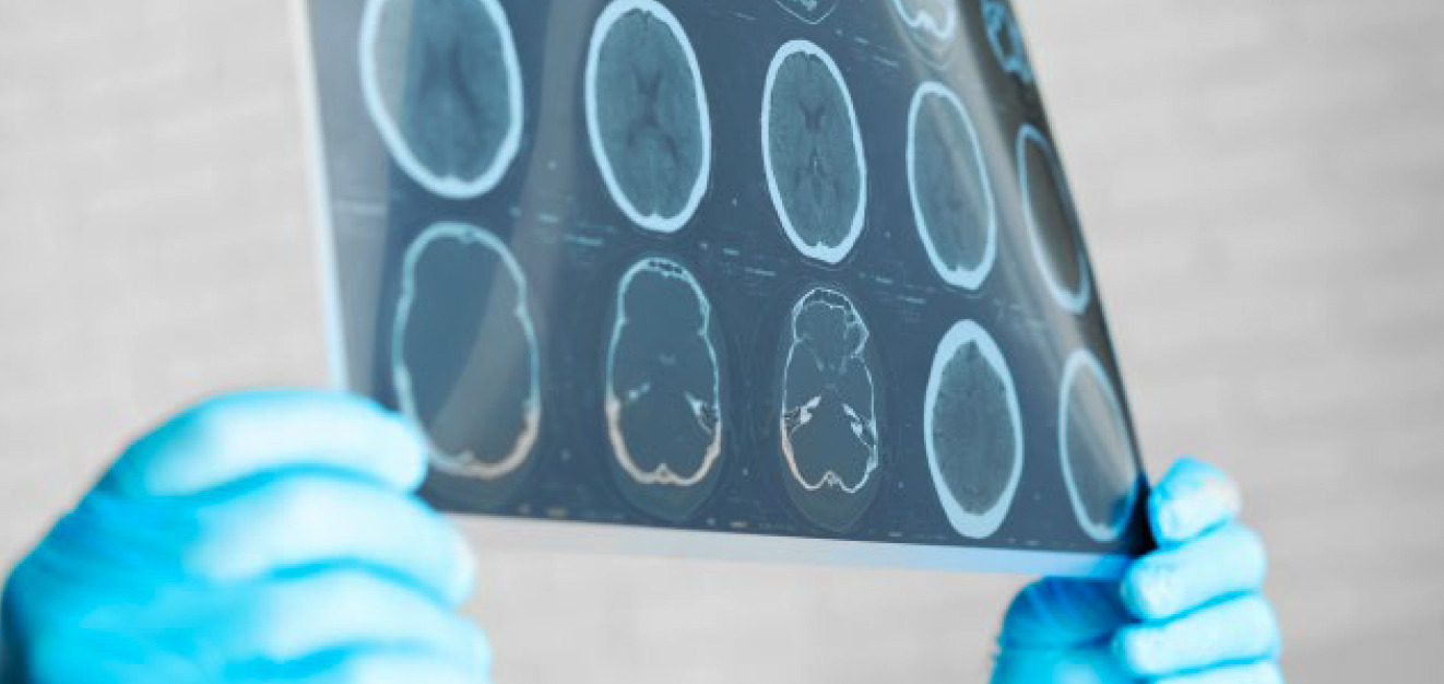 A pair of blue-gloved hands holding up a brain scan image.